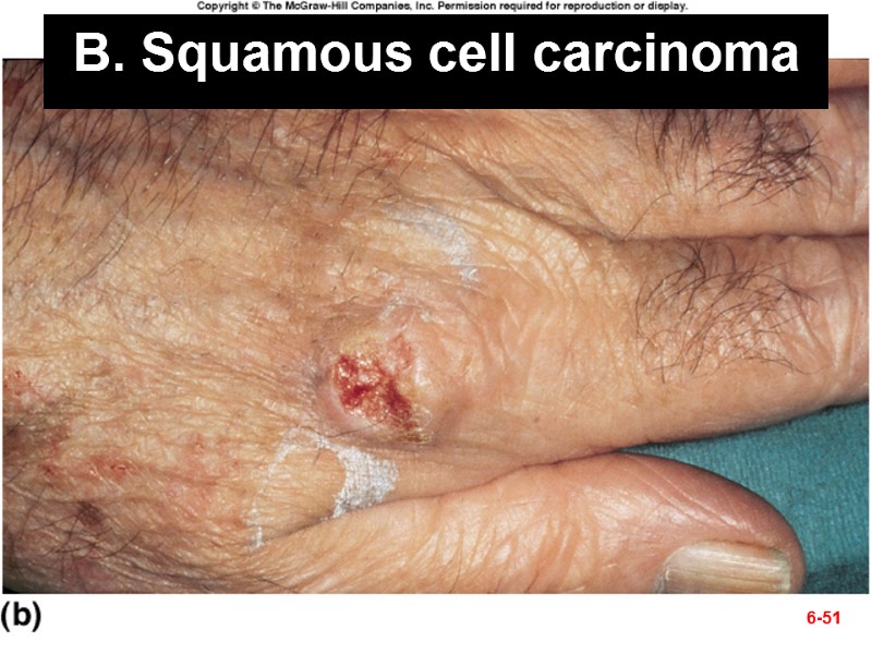 B. Squamous cell carcinoma 6-51